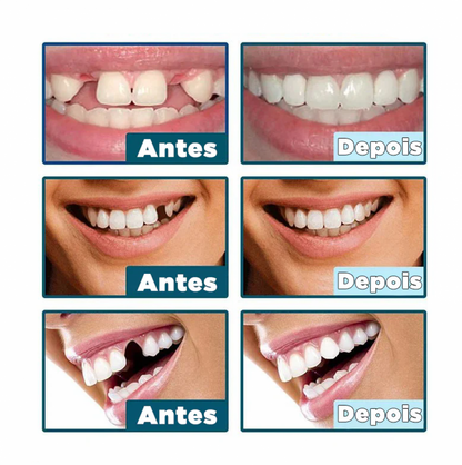 Dentfit - Facetas Dentárias Naturais removíveis ( Superior e Inferior)