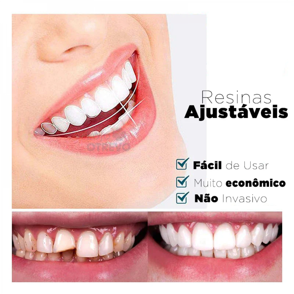 Dentfit - Facetas Dentárias Naturais removíveis ( Superior e Inferior)