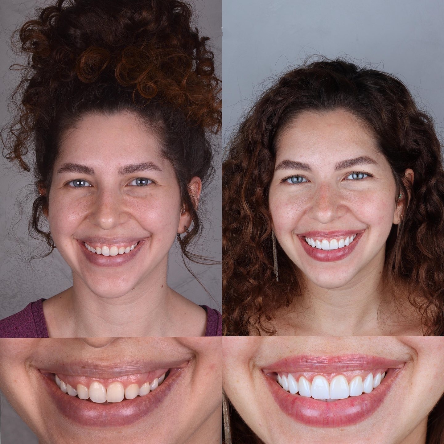 Clareamento Denta