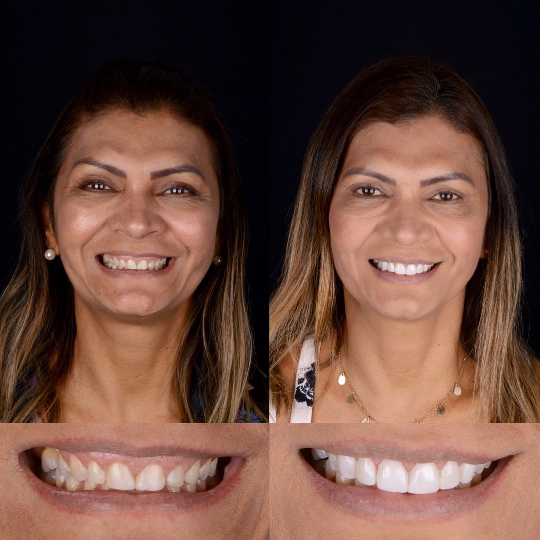 Clareamento Dental