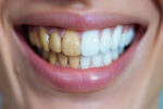 Clareamento Dental