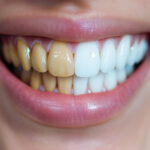 Clareamento Dental
